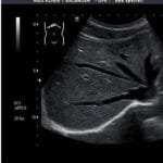 Revolutionizing Medical Imaging: The Hand Held Ultrasound Scanner